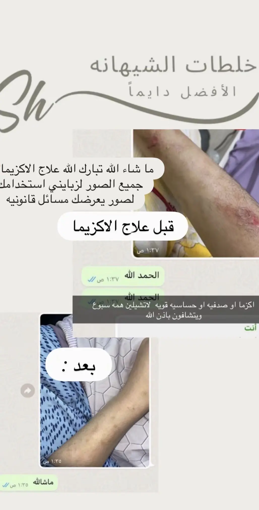 كريم  الاكزيما ، الصدفيه " الشيهانه الخبيره 🥇 "