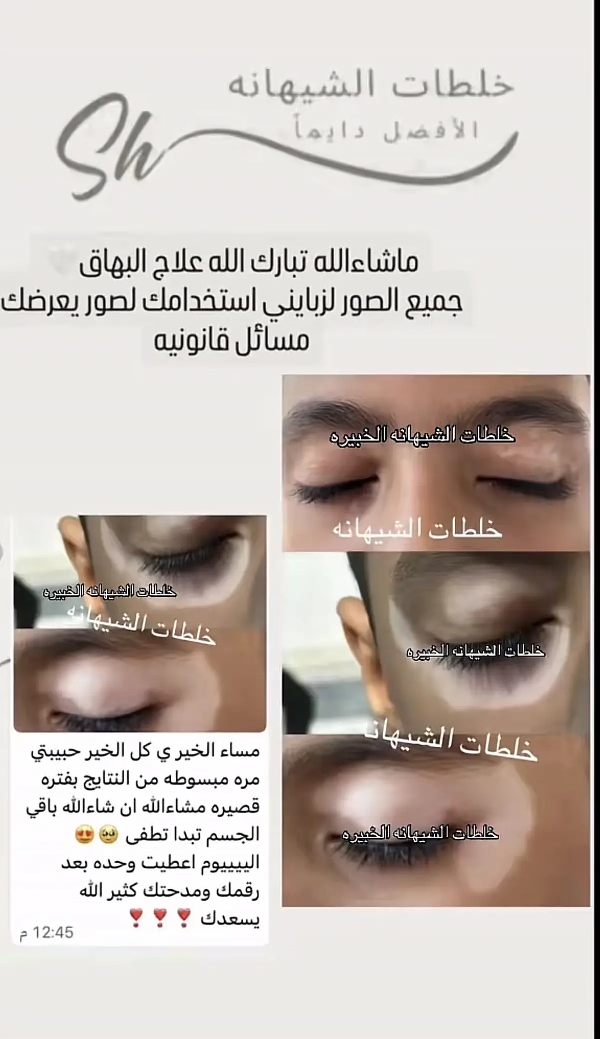 كريم البهاق ، الشيهانه الخبيره🥇