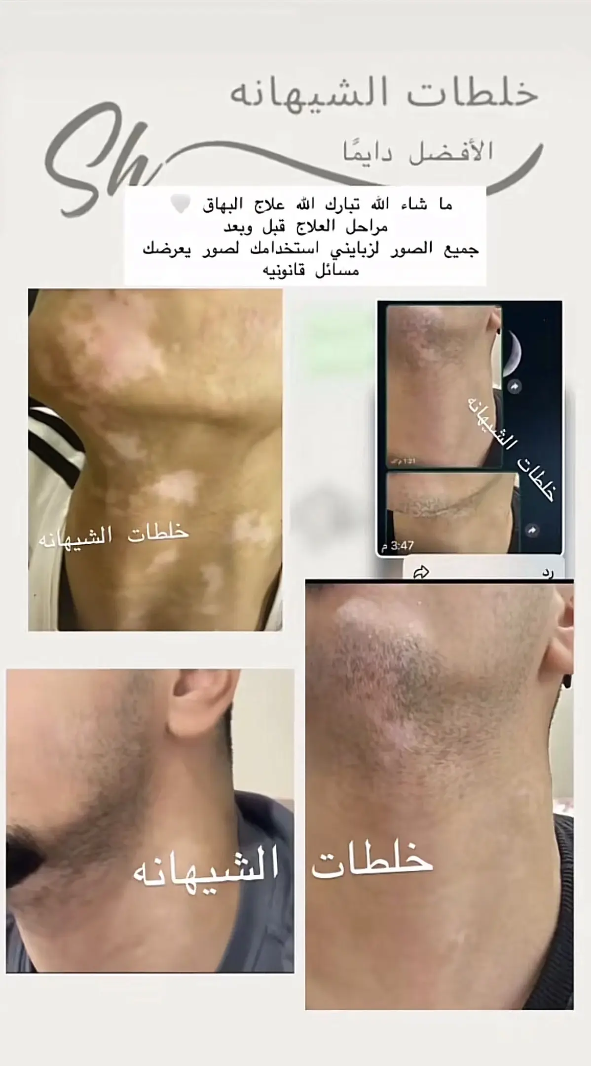 كريم البهاق ، الشيهانه الخبيره🥇