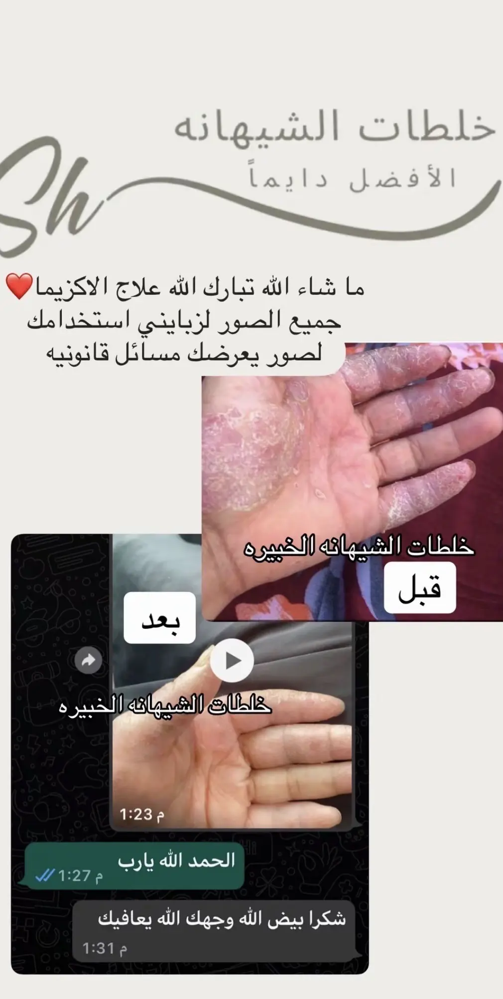 كريم  الاكزيما ، الصدفيه " الشيهانه الخبيره 🥇 "