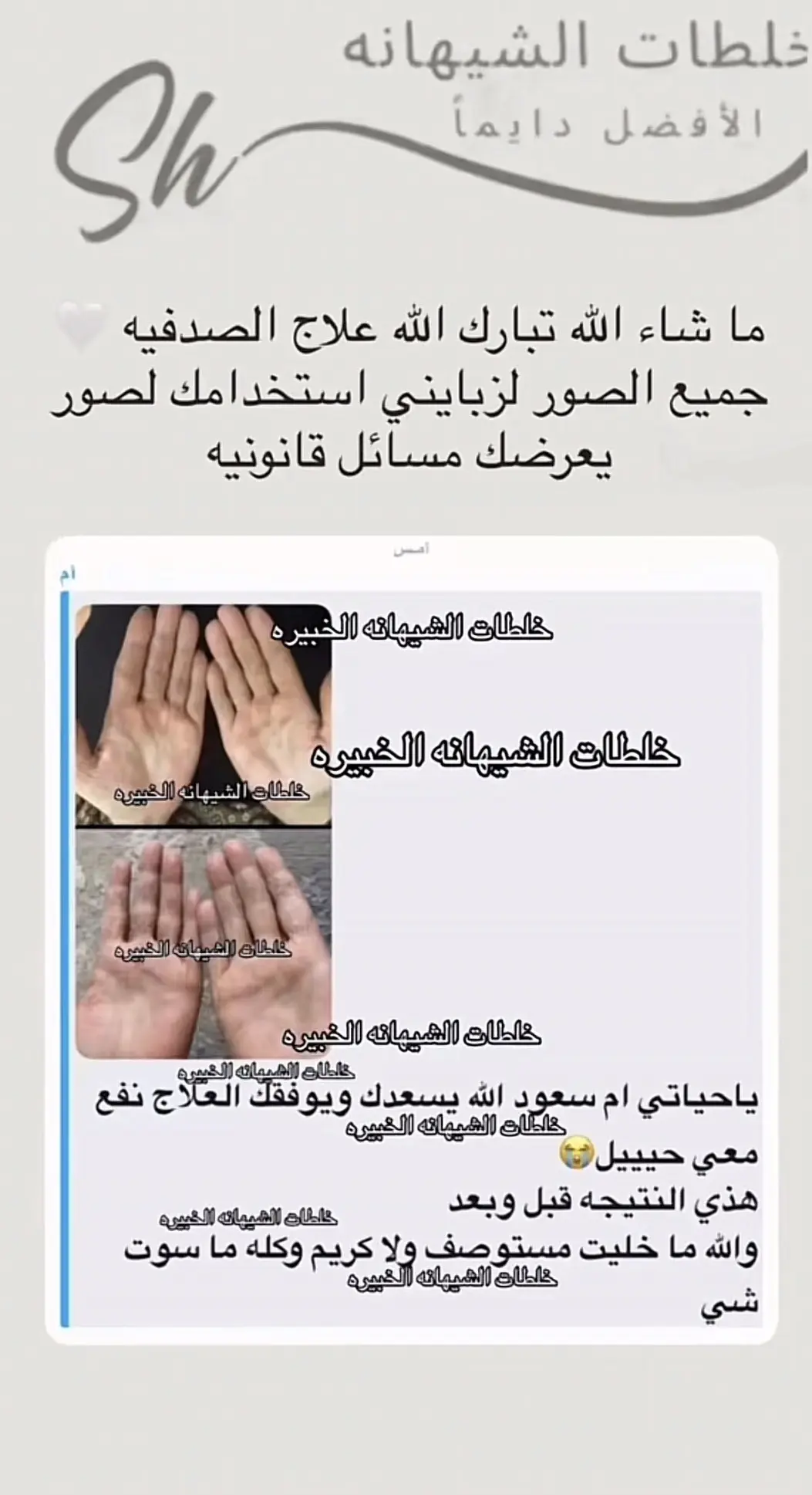 كريم  الاكزيما ، الصدفيه " الشيهانه الخبيره 🥇 "