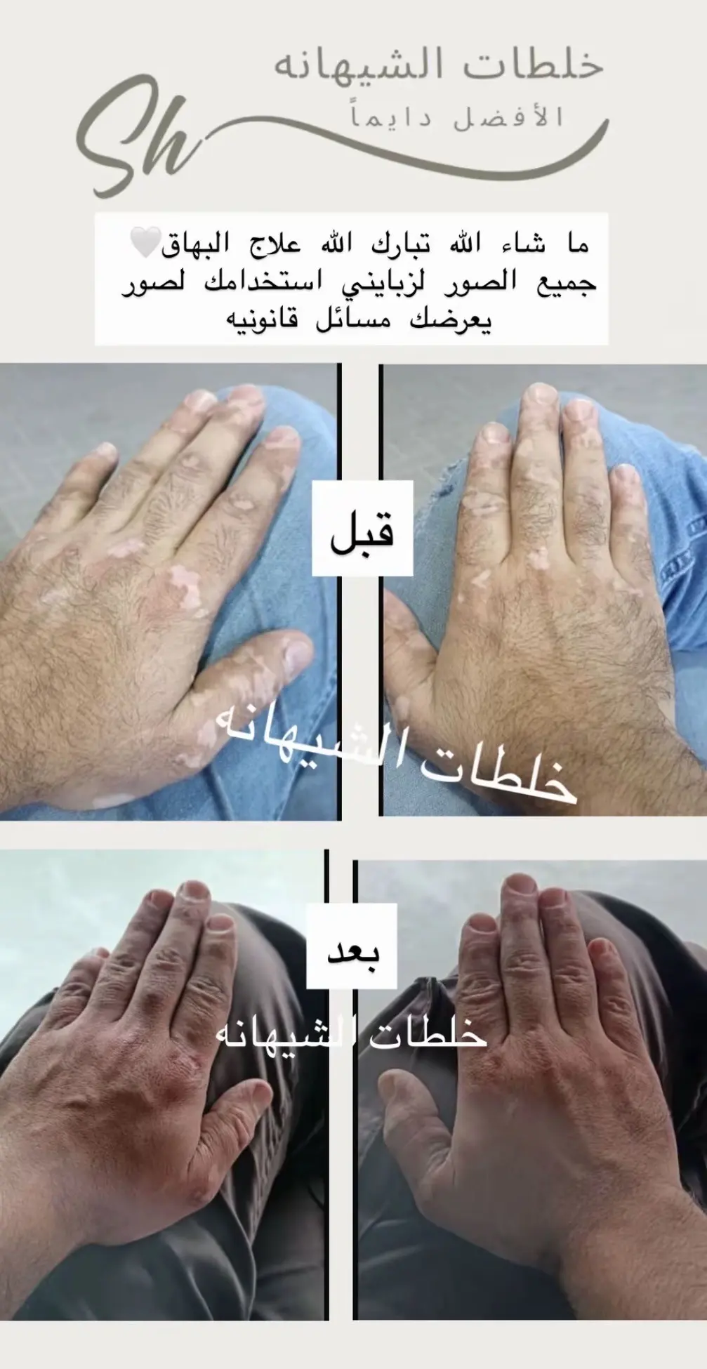كريم البهاق ، الشيهانه الخبيره🥇