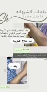 كريم  الاكزيما ، الصدفيه " الشيهانه الخبيره 🥇 "