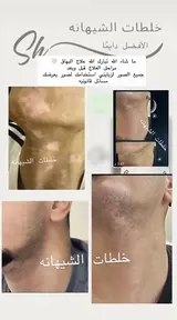 كريم البهاق ، الشيهانه الخبيره🥇