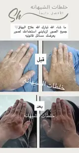 كريم البهاق ، الشيهانه الخبيره🥇